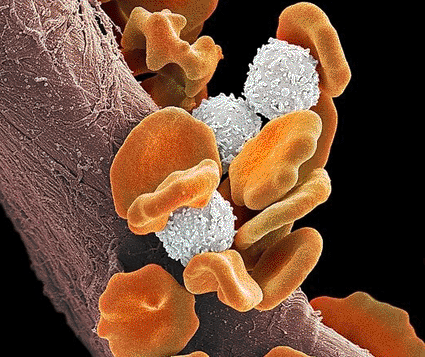 Image: Colored scanning electron micrograph (SEM) of red blood cells (erythorocytes, orange) and B lymphocyte white blood cells (white) from a patient with leukemia (photo courtesy Steve Gschmeissner / Science Photo Library).